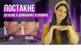 Лечение постакне в 2022. Восстановление кожи лица дома. Постакне и рубцы.