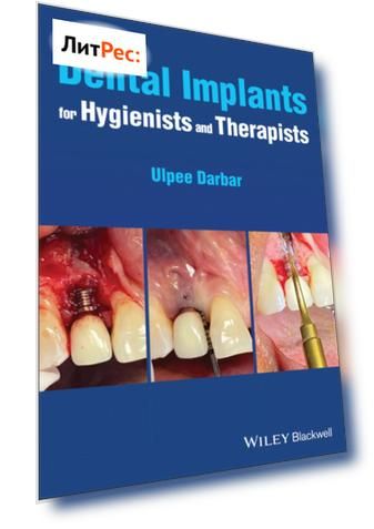 Dental Implants for Hygienists and Therapists